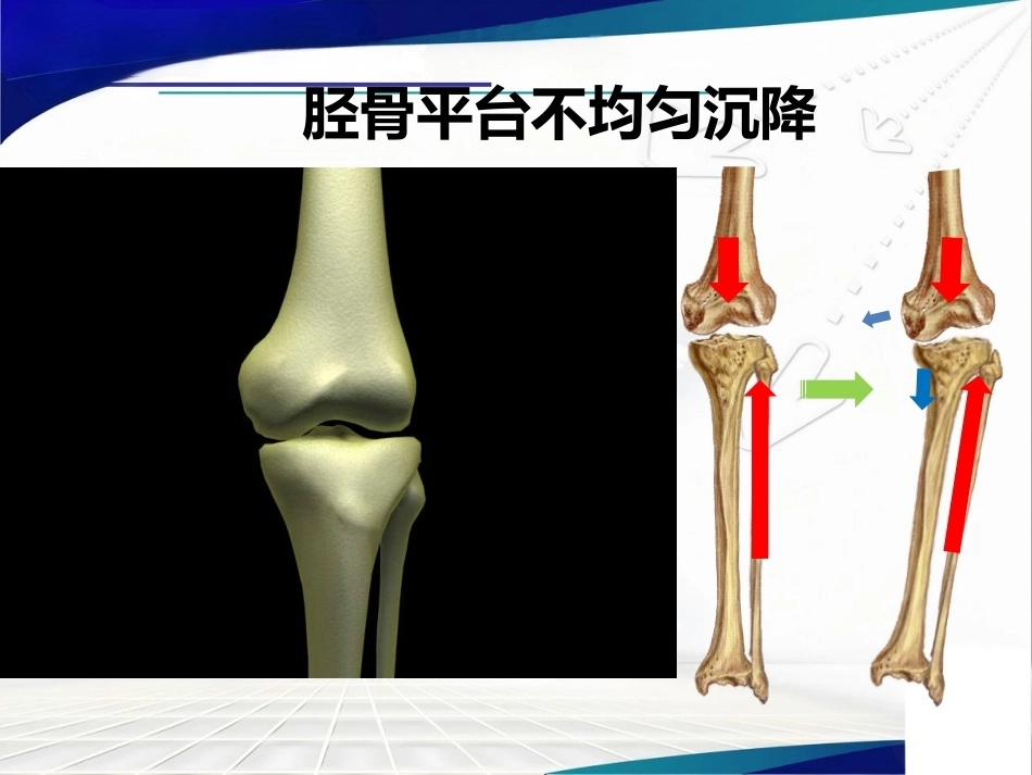 胫骨 平台不均匀沉降_第10页