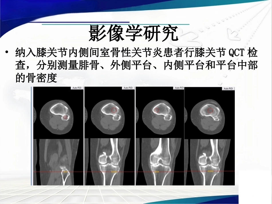 胫骨 平台不均匀沉降_第12页