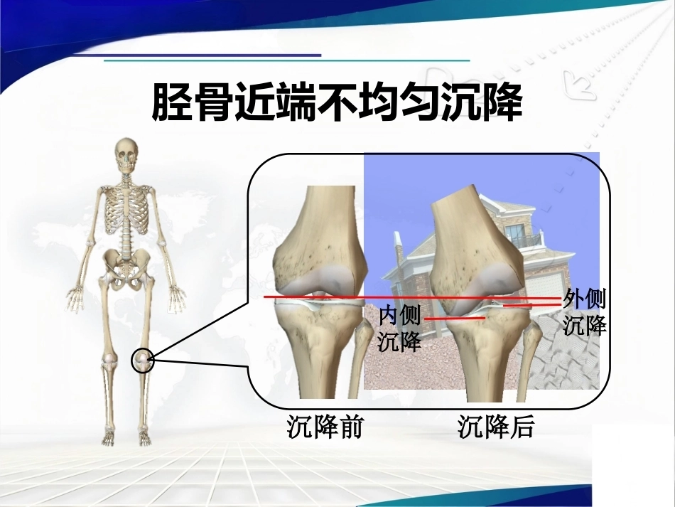 胫骨 平台不均匀沉降_第8页