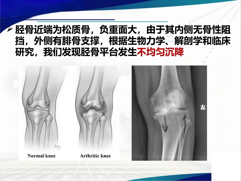 胫骨 平台不均匀沉降_第9页