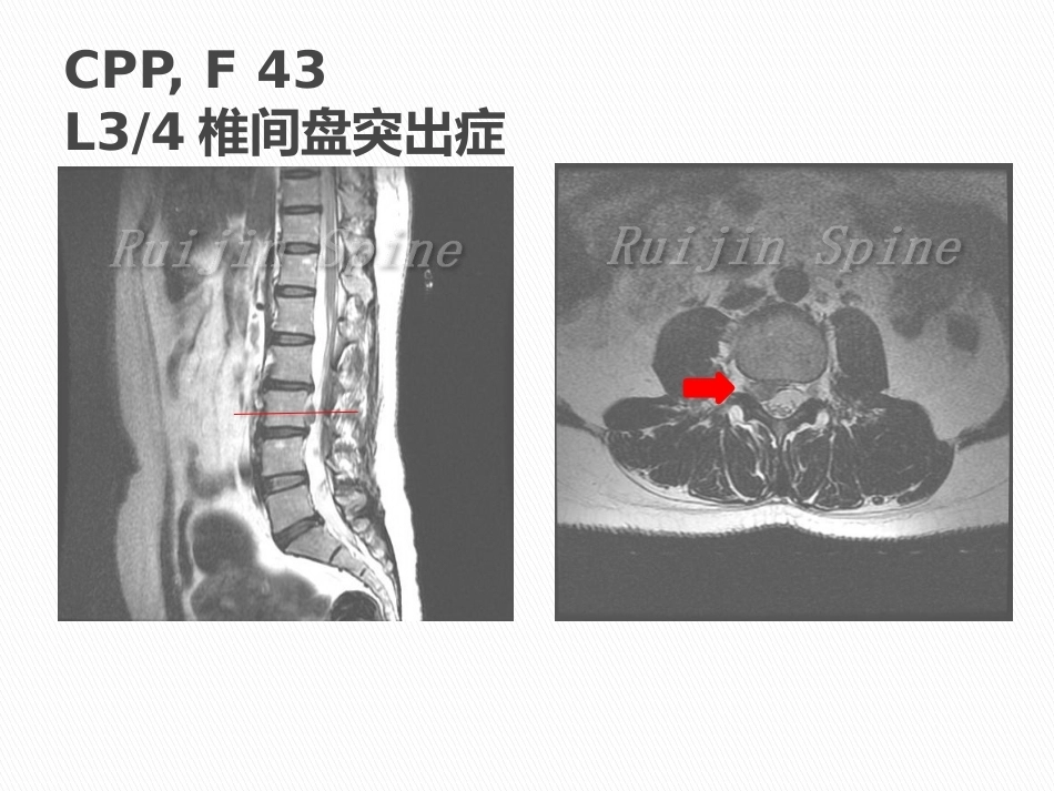 显微镜辅助手术治疗腰椎 退行性疾病_第10页