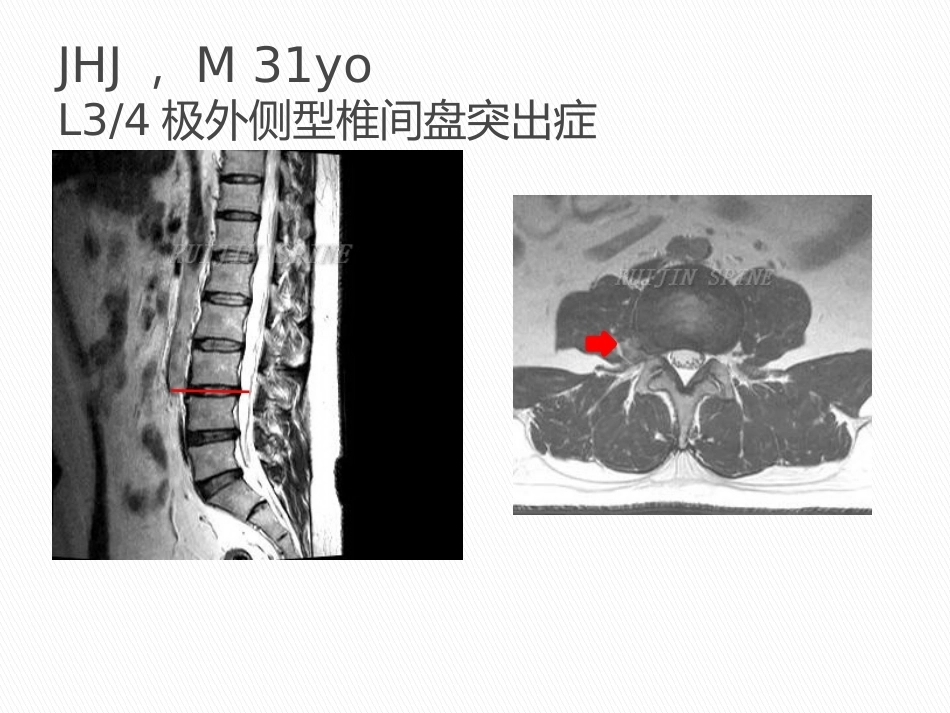显微镜辅助手术治疗腰椎 退行性疾病_第15页