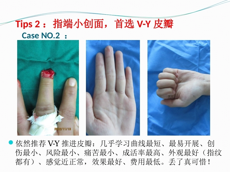 手指创面皮瓣修复的六项原则_第5页
