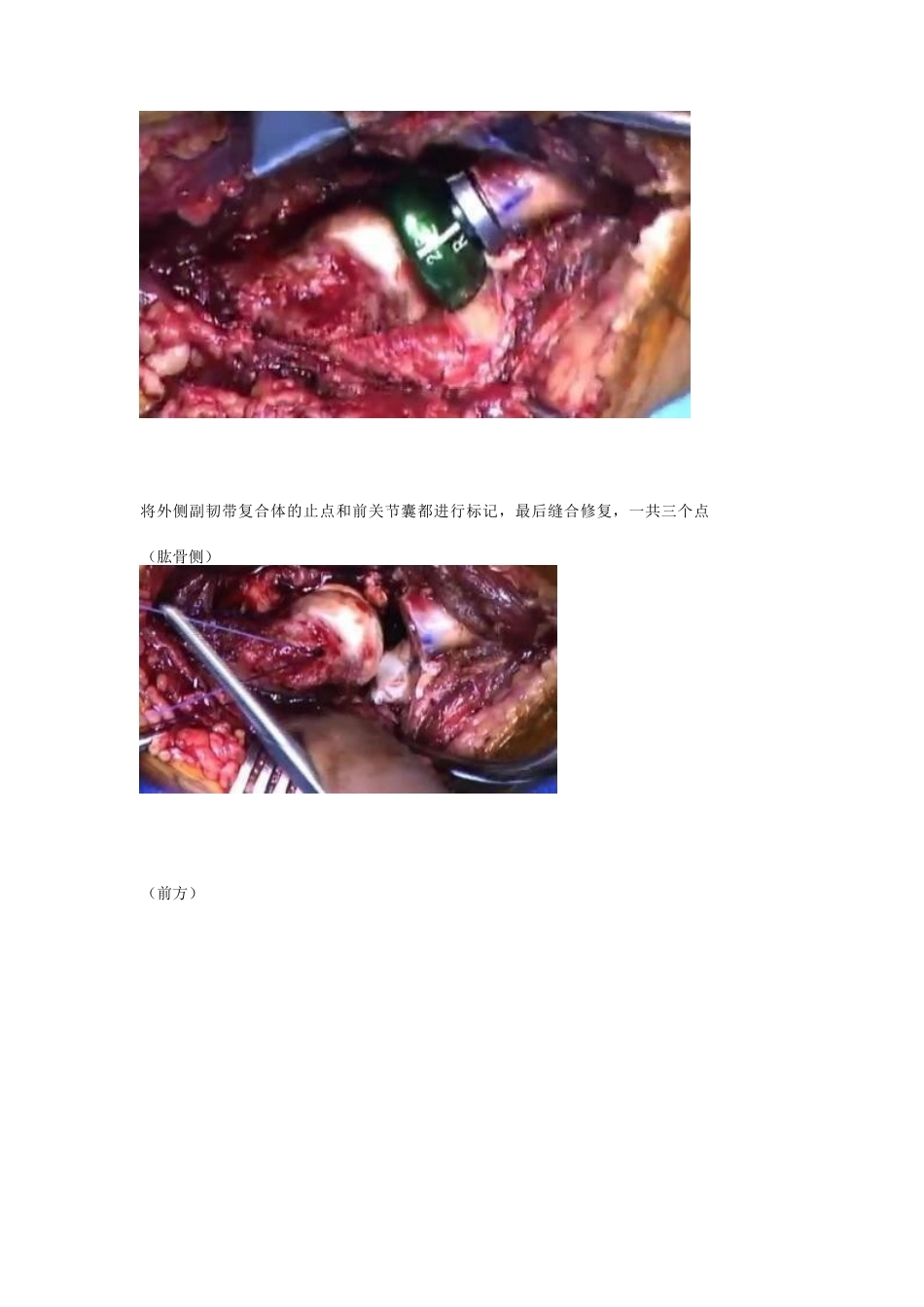 肘关节恐怖三联征 治疗策略与技巧_第7页