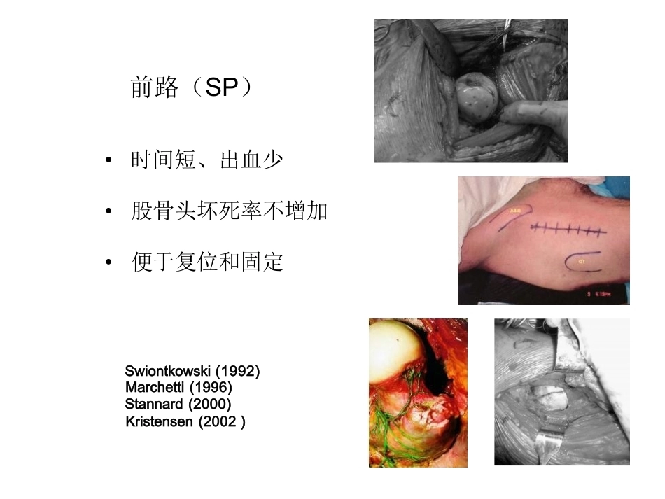 股骨头 骨折入路选择_第14页