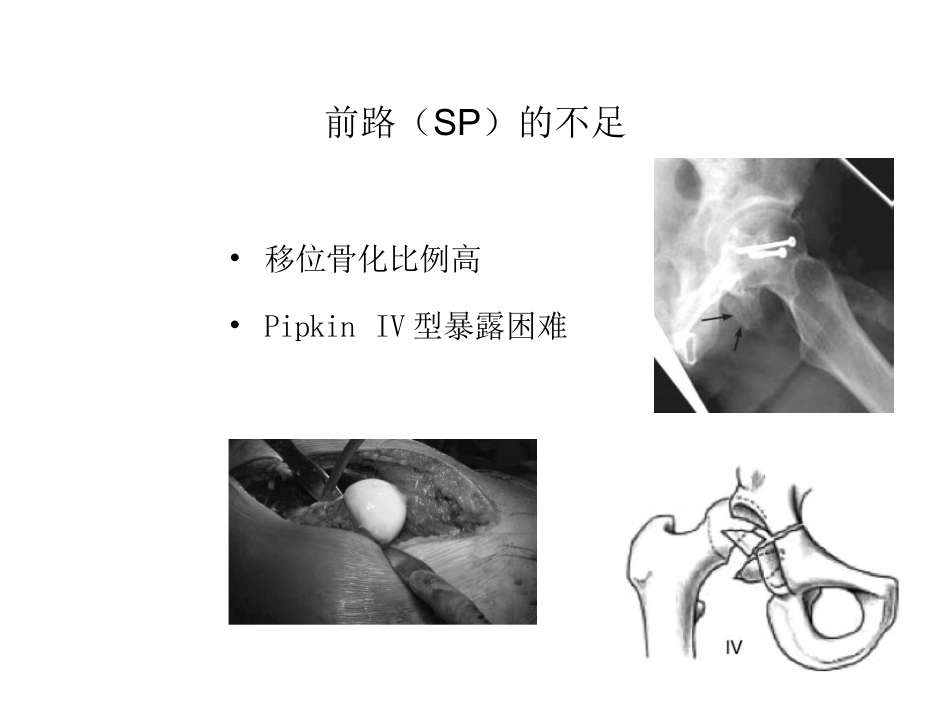 股骨头 骨折入路选择_第15页