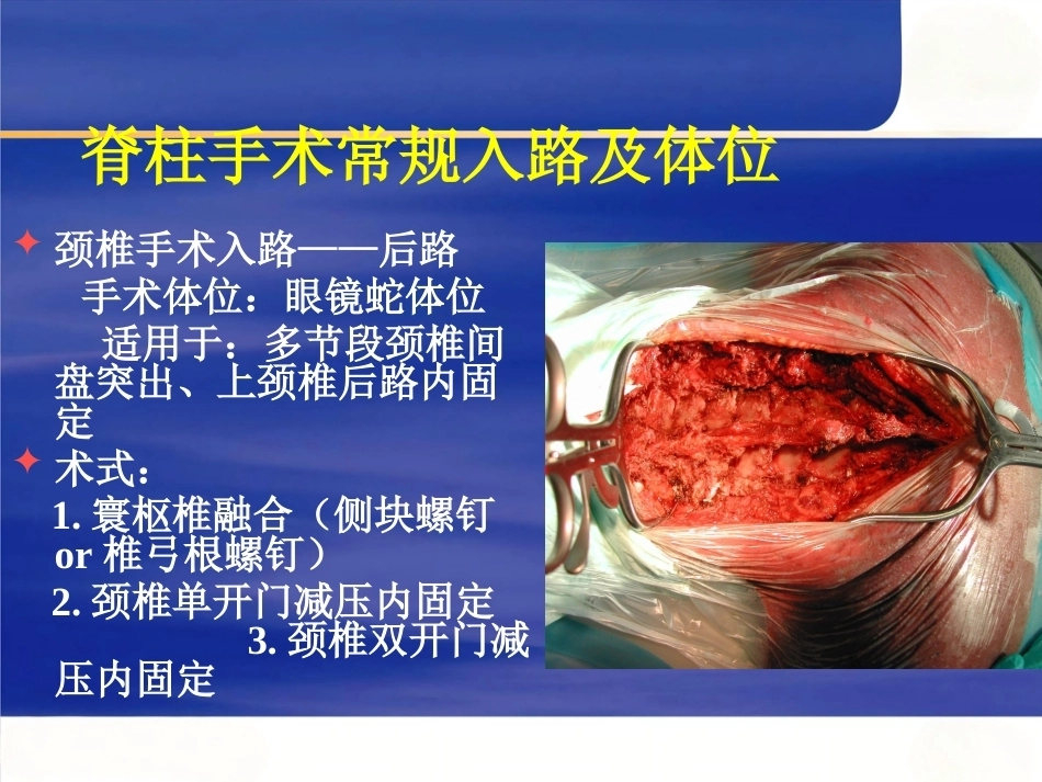 脊柱手术 体位摆放要点_第14页