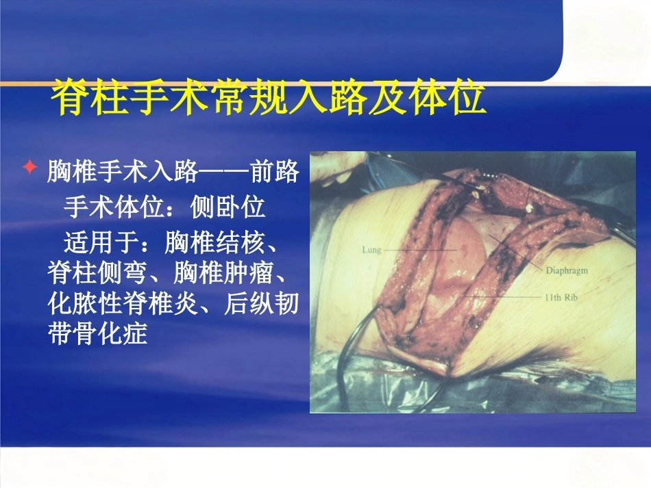 脊柱手术 体位摆放要点_第15页