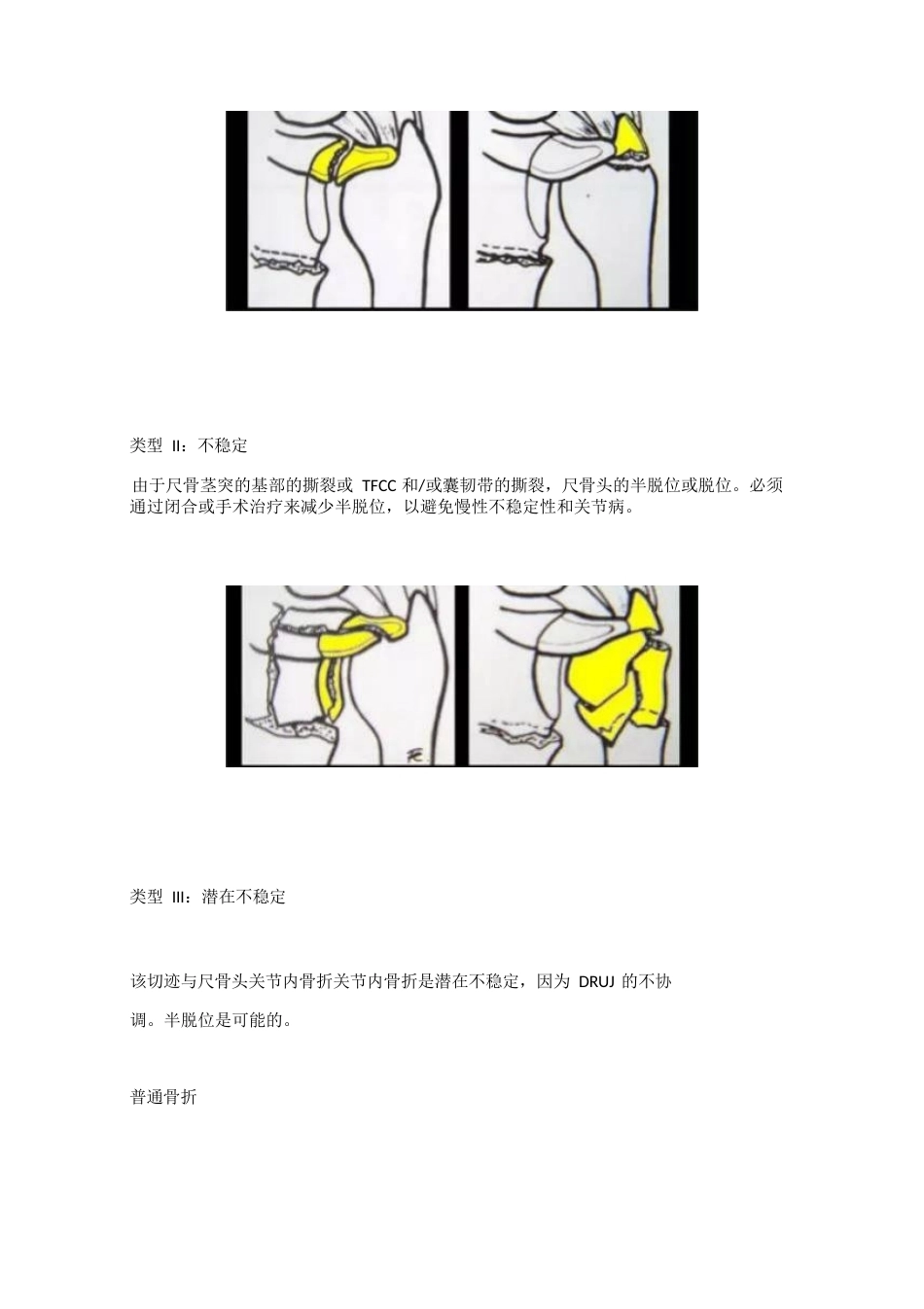 腕关节骨折的影像、分型_第10页