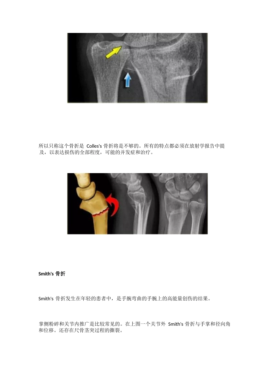 腕关节骨折的影像、分型_第12页