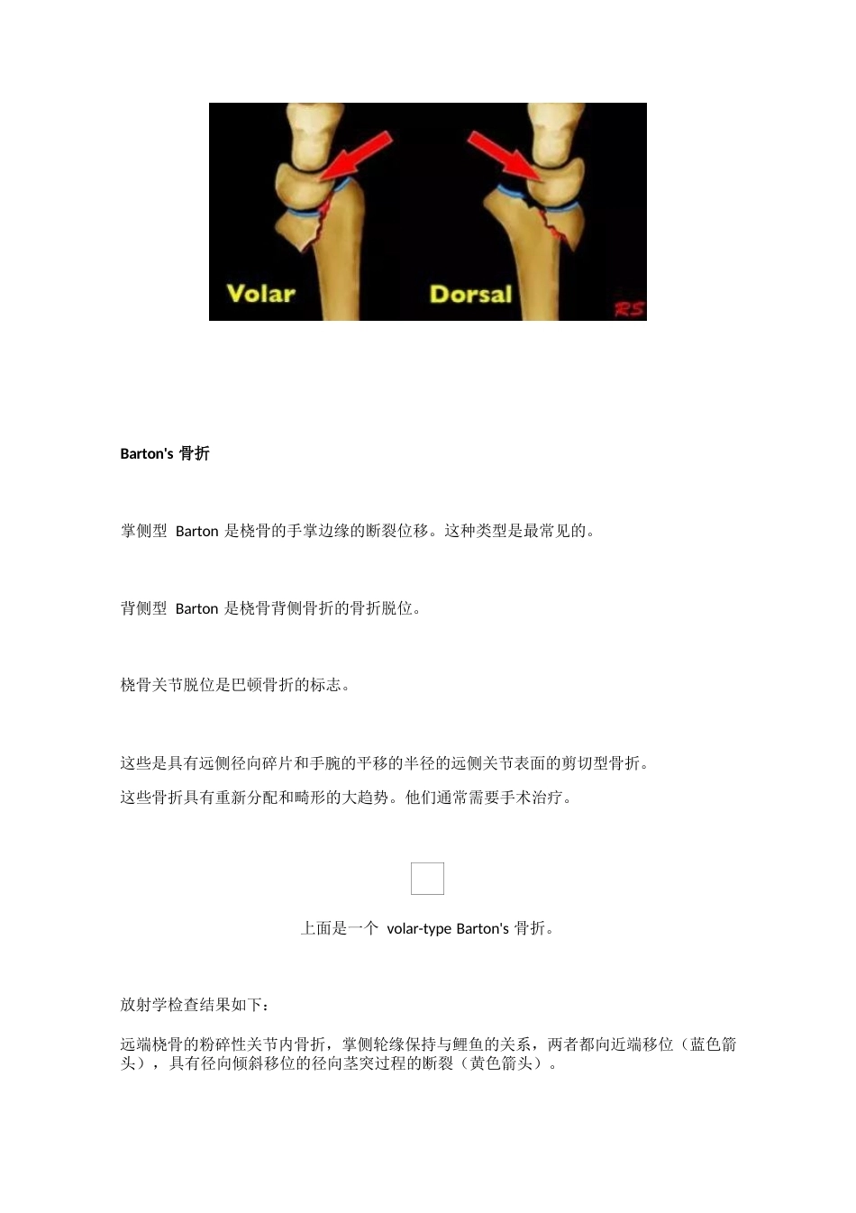 腕关节骨折的影像、分型_第13页