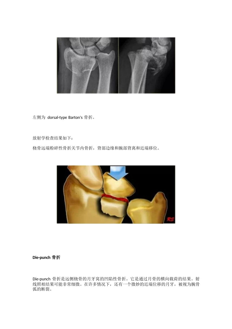 腕关节骨折的影像、分型_第14页