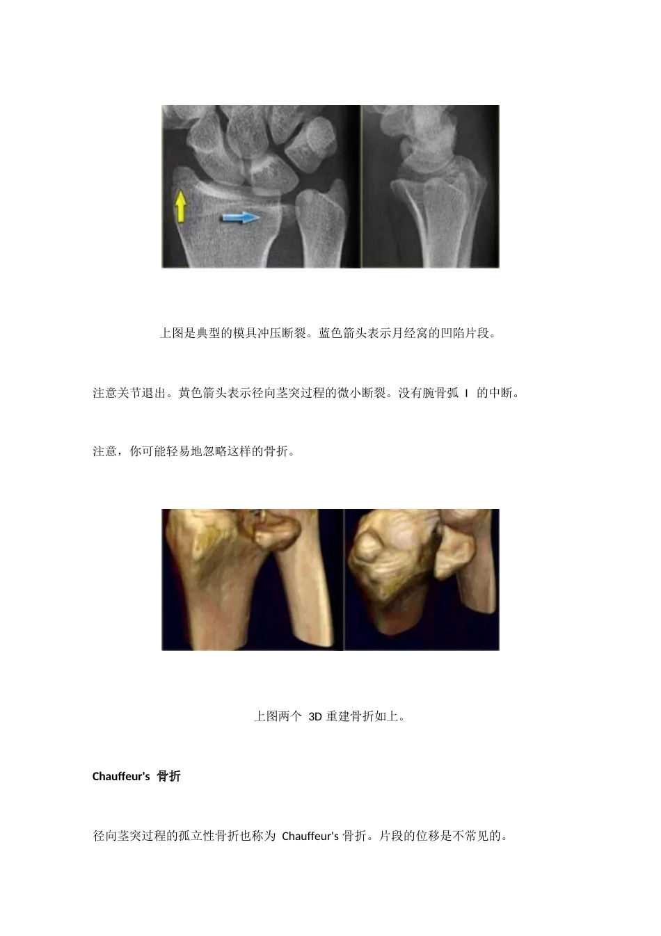 腕关节骨折的影像、分型_第15页