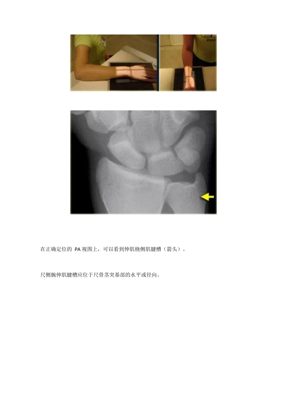 腕关节骨折的影像、分型_第2页