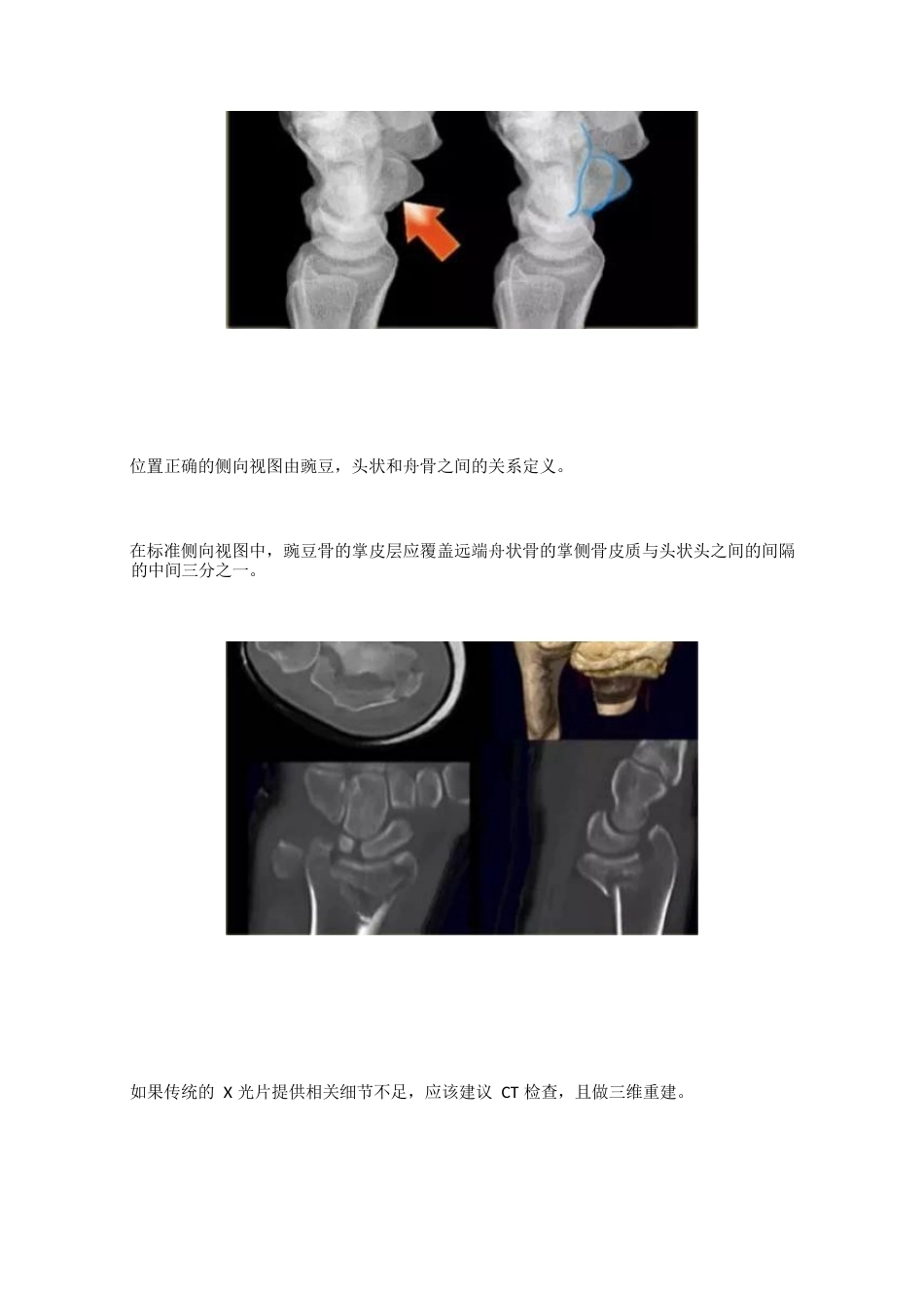 腕关节骨折的影像、分型_第3页