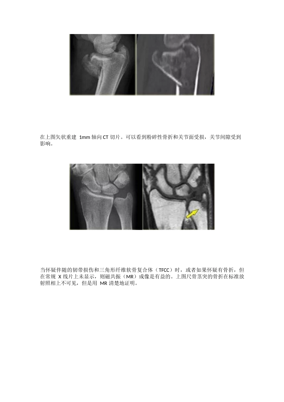 腕关节骨折的影像、分型_第4页