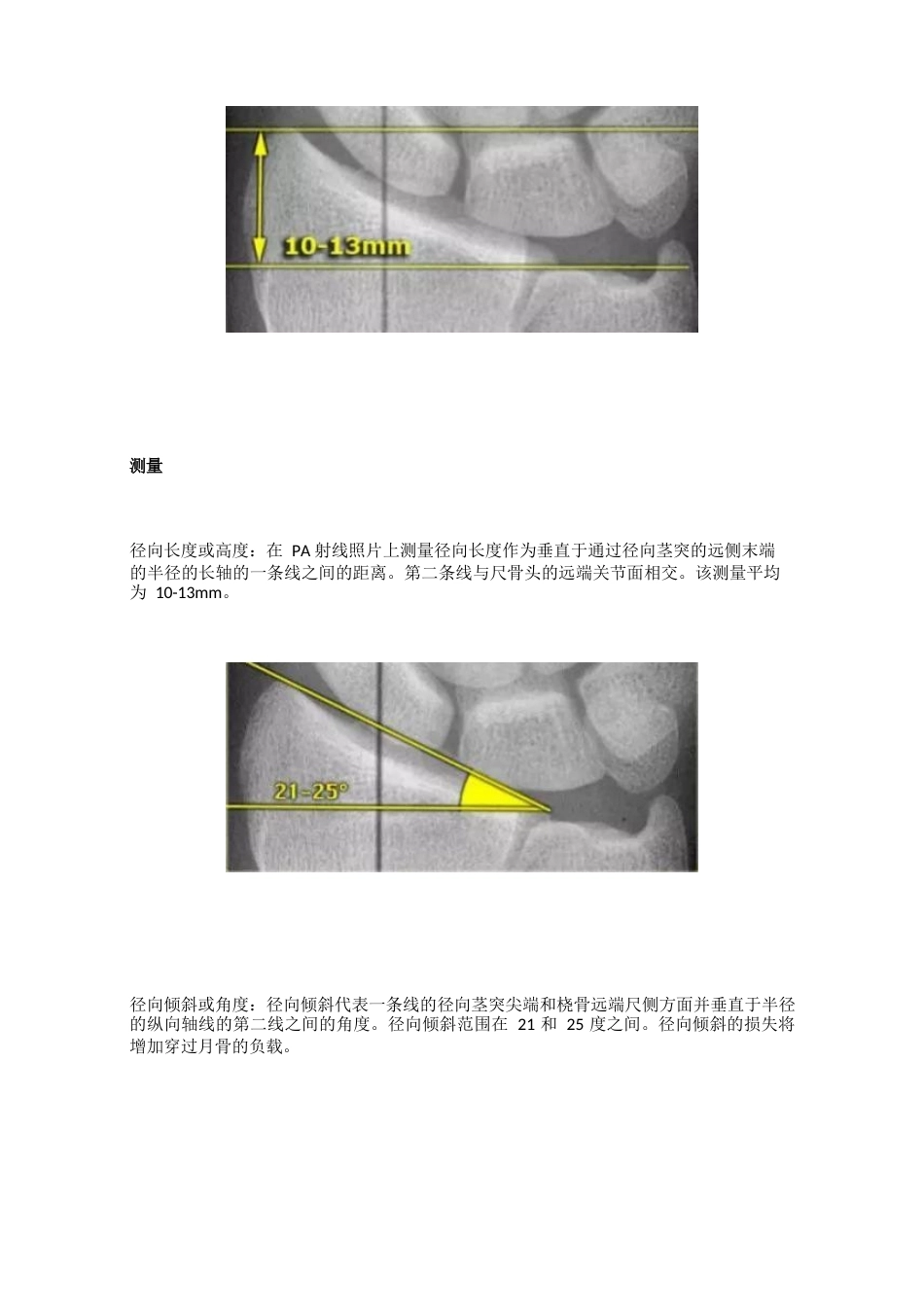 腕关节骨折的影像、分型_第5页