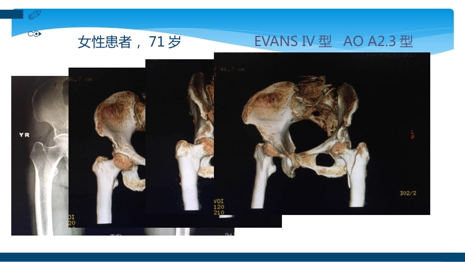 股骨粗隆间及粗隆下骨折髓内固定辅助技术分享_第14页