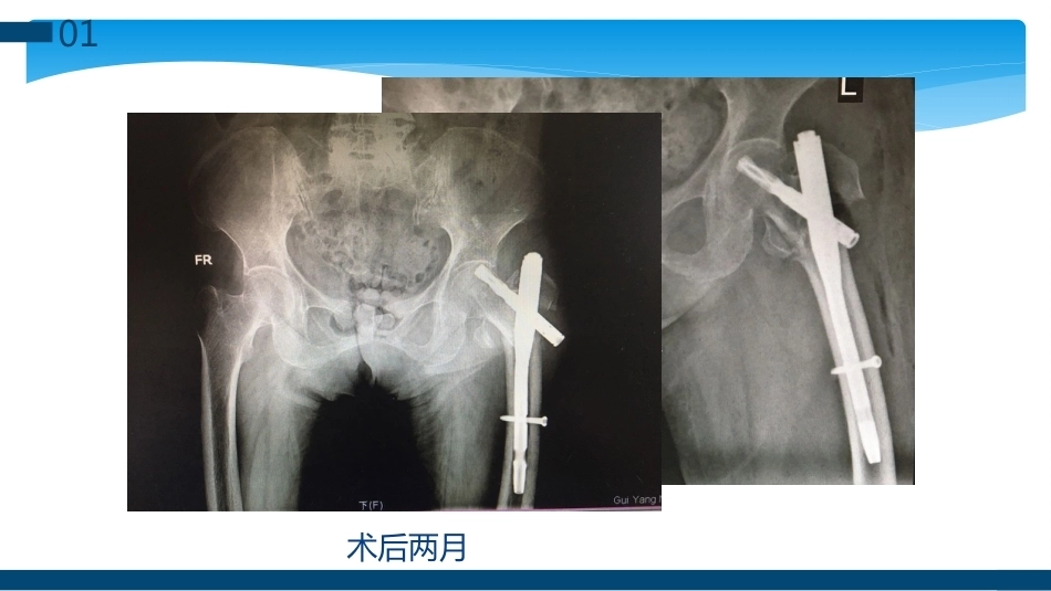 股骨粗隆间及粗隆下骨折髓内固定辅助技术分享_第5页