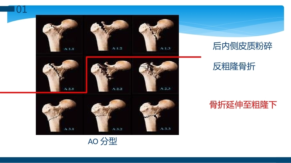 股骨粗隆间及粗隆下骨折髓内固定辅助技术分享_第8页
