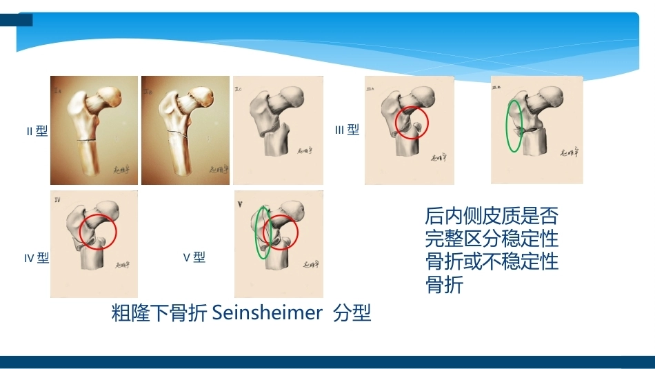 股骨粗隆间及粗隆下骨折髓内固定辅助技术分享_第9页