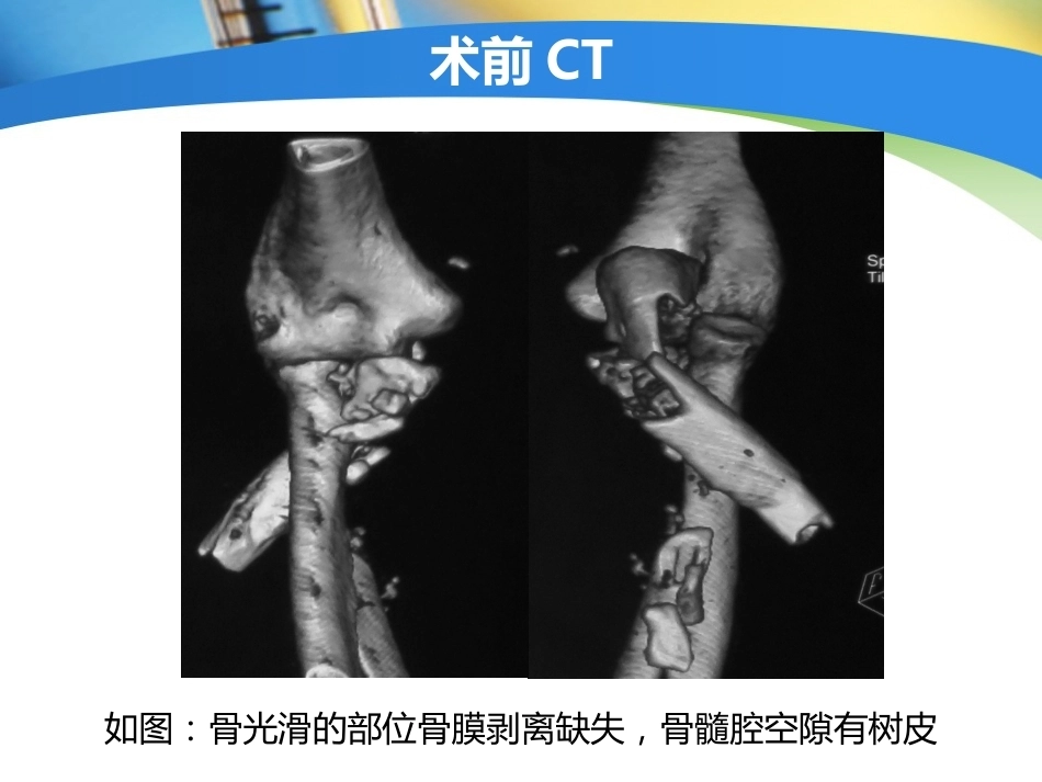 上肢外伤手术技 术与技巧_第10页