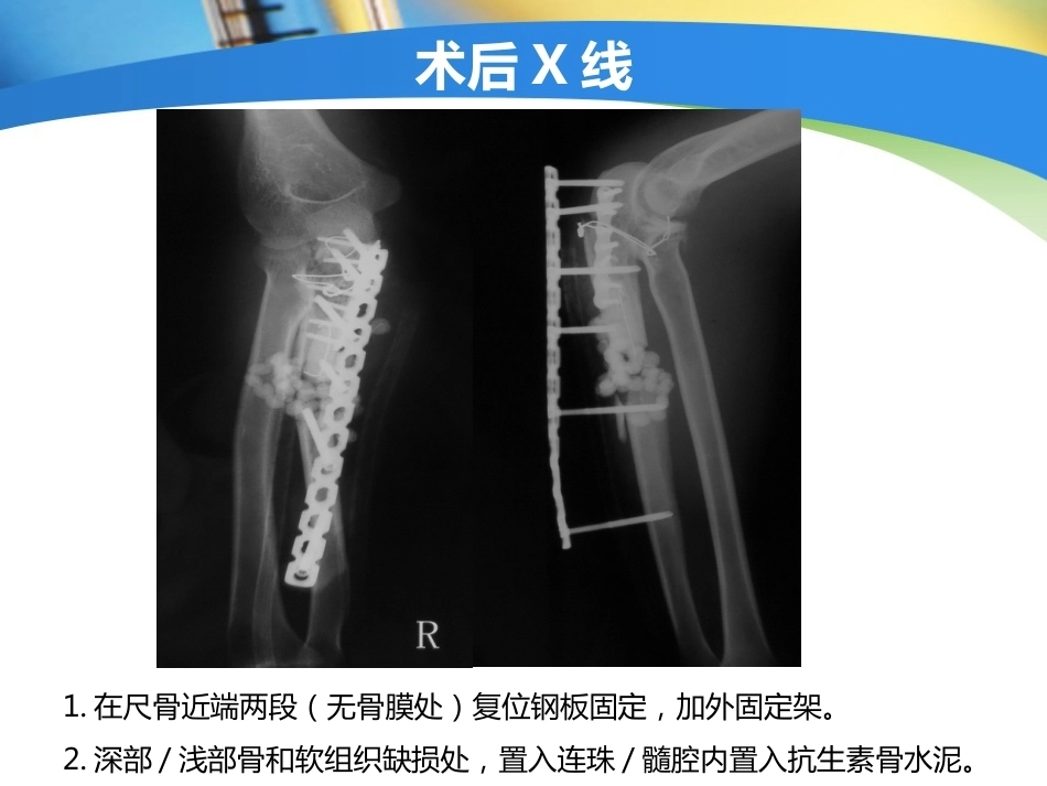 上肢外伤手术技 术与技巧_第13页