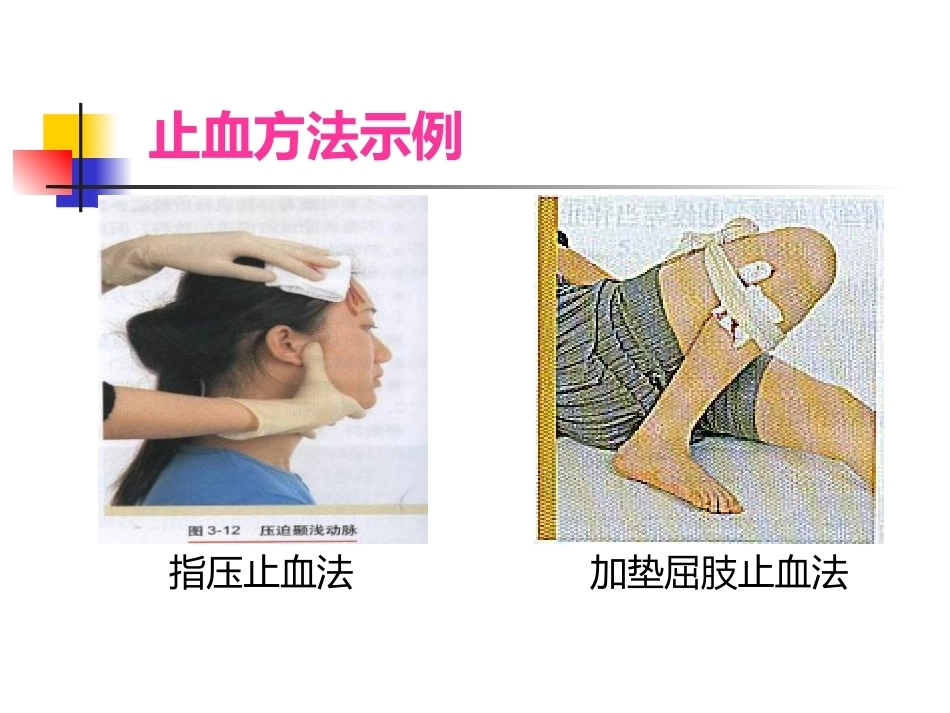 常见 外伤的急救_第10页