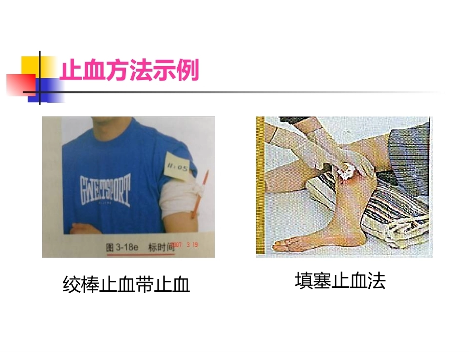 常见 外伤的急救_第11页