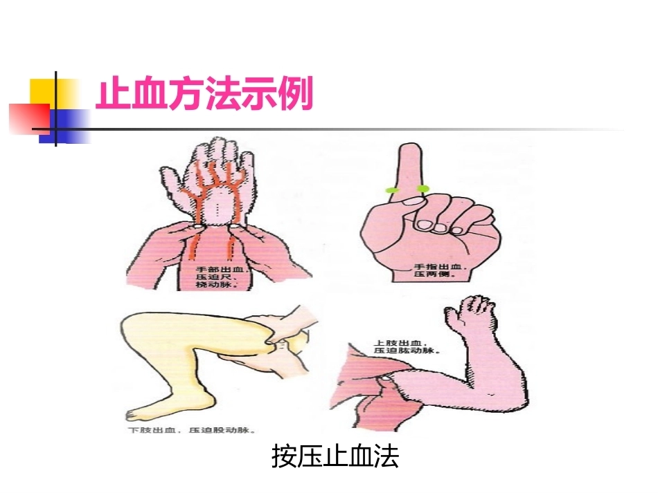 常见 外伤的急救_第9页