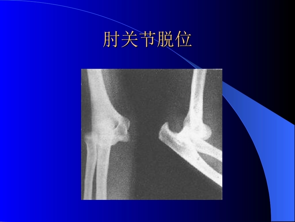 骨科常见疾病的X线表现_第10页