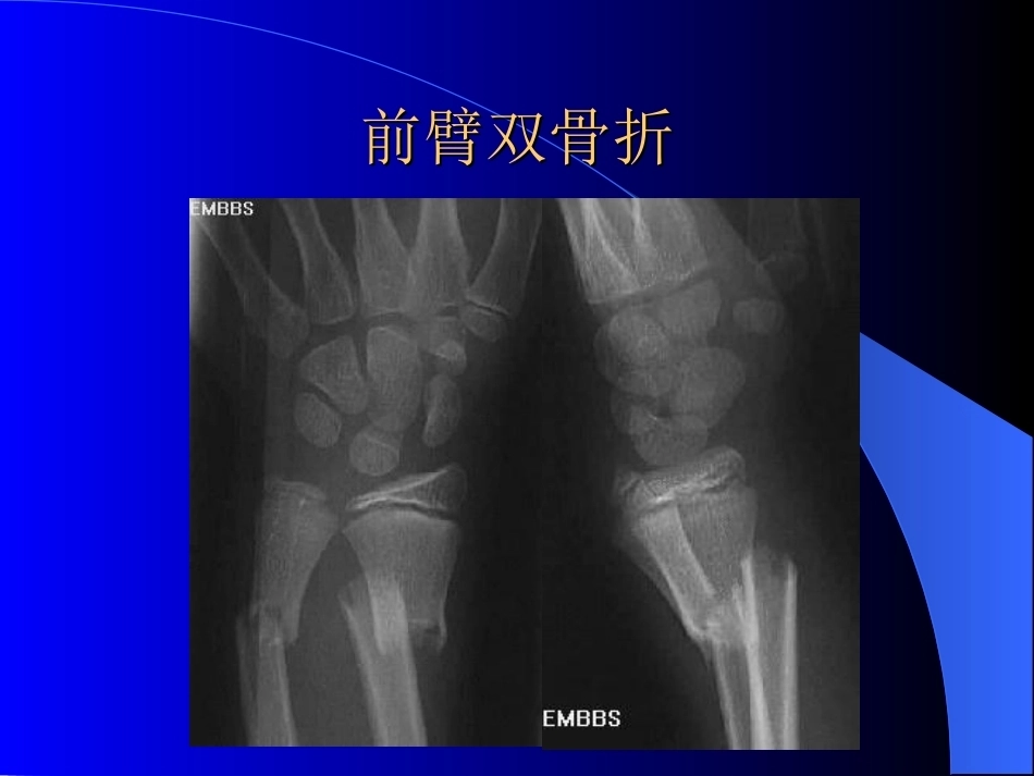 骨科常见疾病的X线表现_第14页