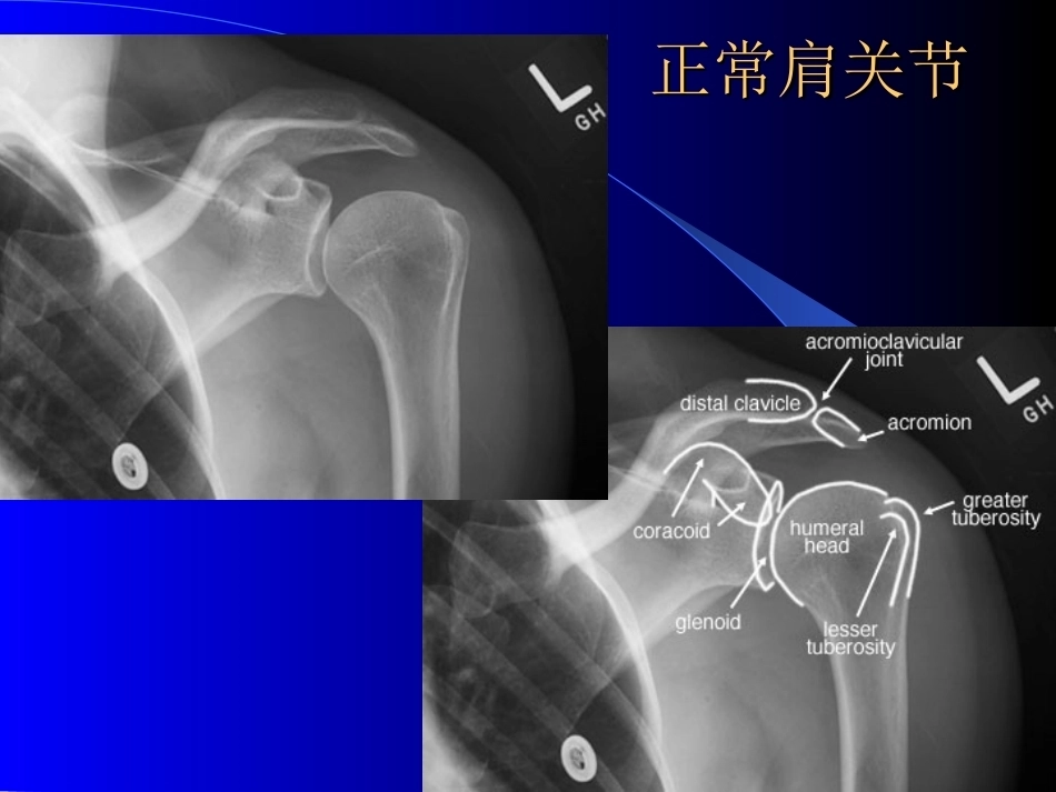 骨科常见疾病的X线表现_第2页