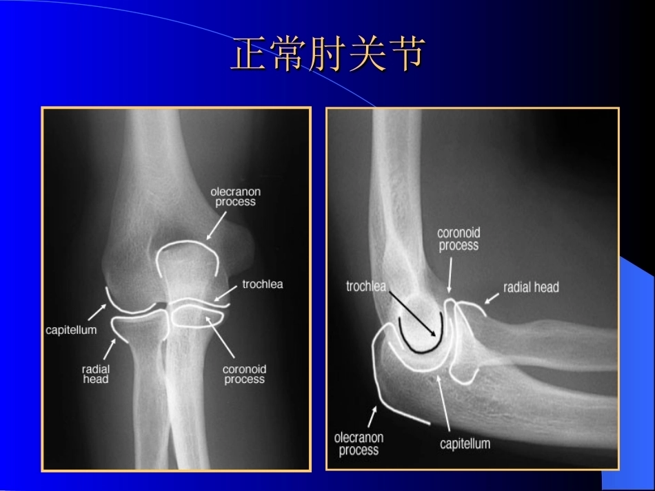 骨科常见疾病的X线表现_第9页