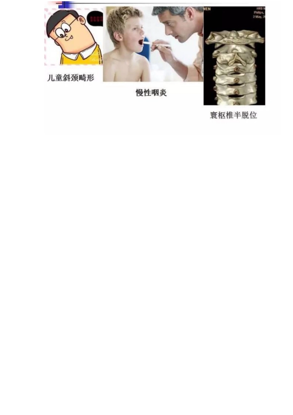 颈椎病的分型与治疗要点_第14页
