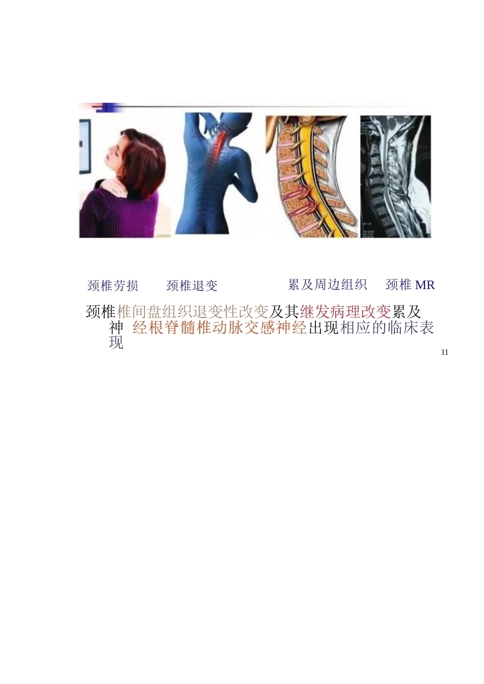 颈椎病的分型与治疗要点_第9页
