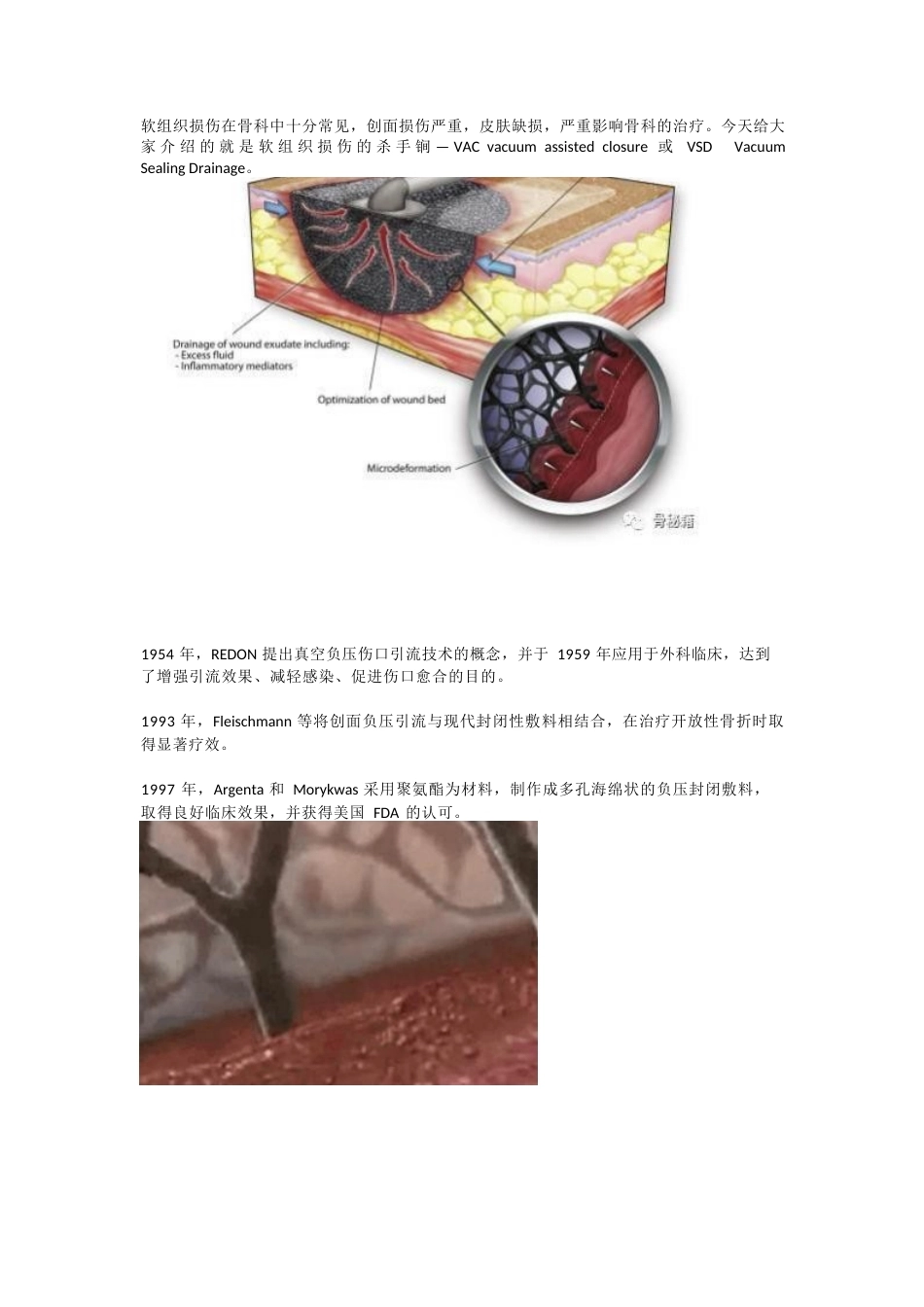 负压封闭引流技术治疗 软组织损伤_第1页