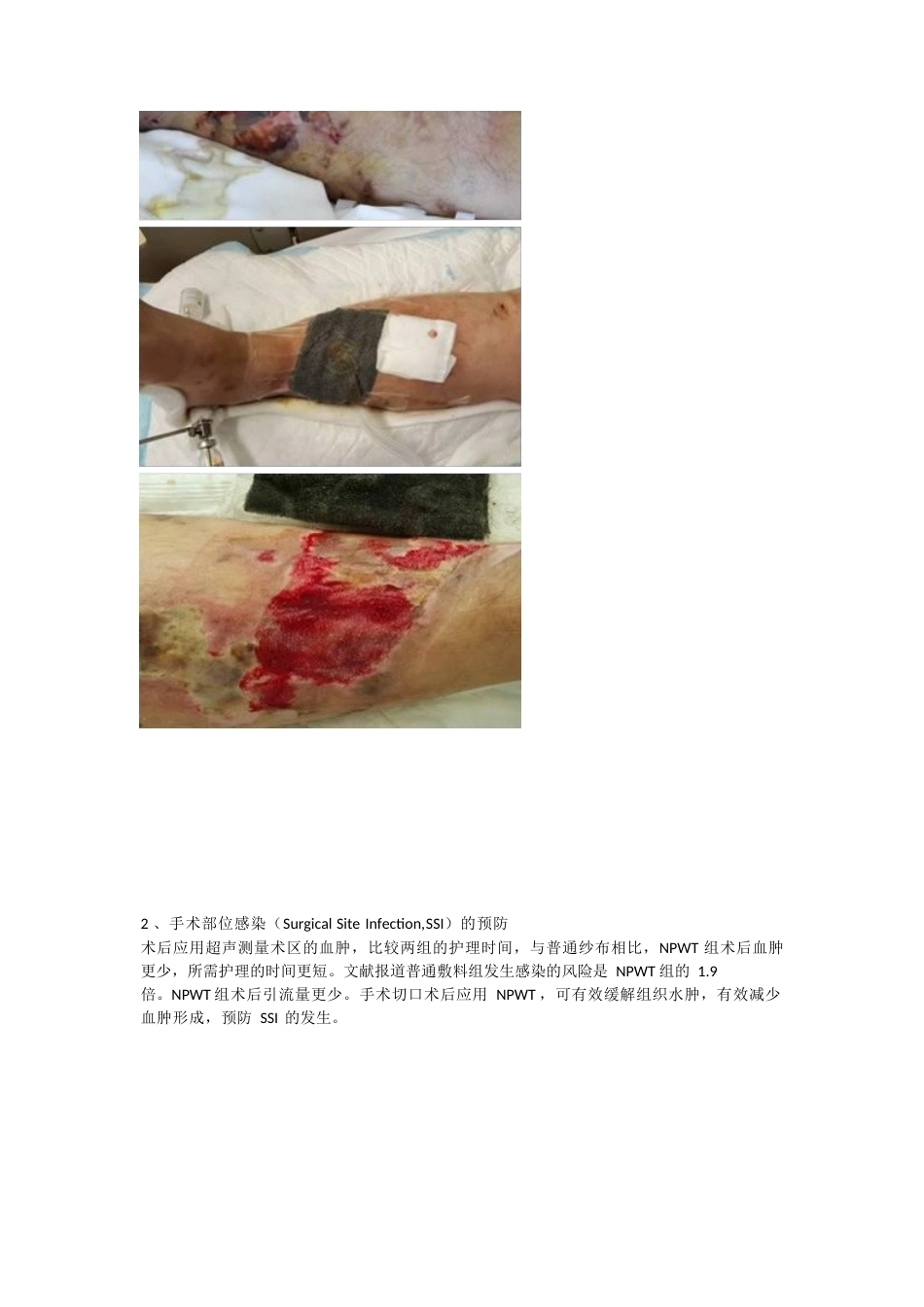 负压封闭引流技术治疗 软组织损伤_第4页