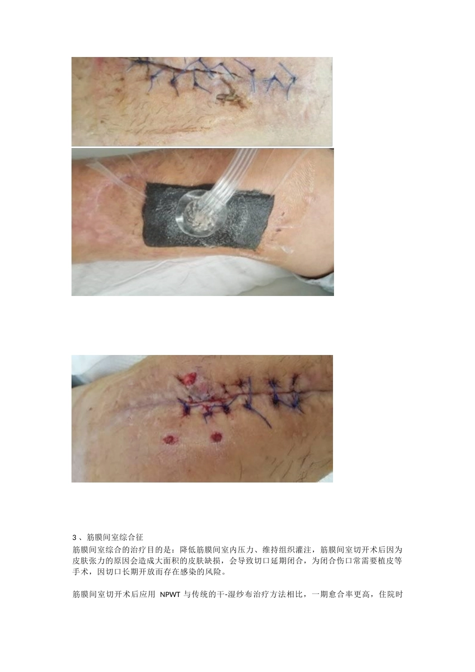 负压封闭引流技术治疗 软组织损伤_第5页