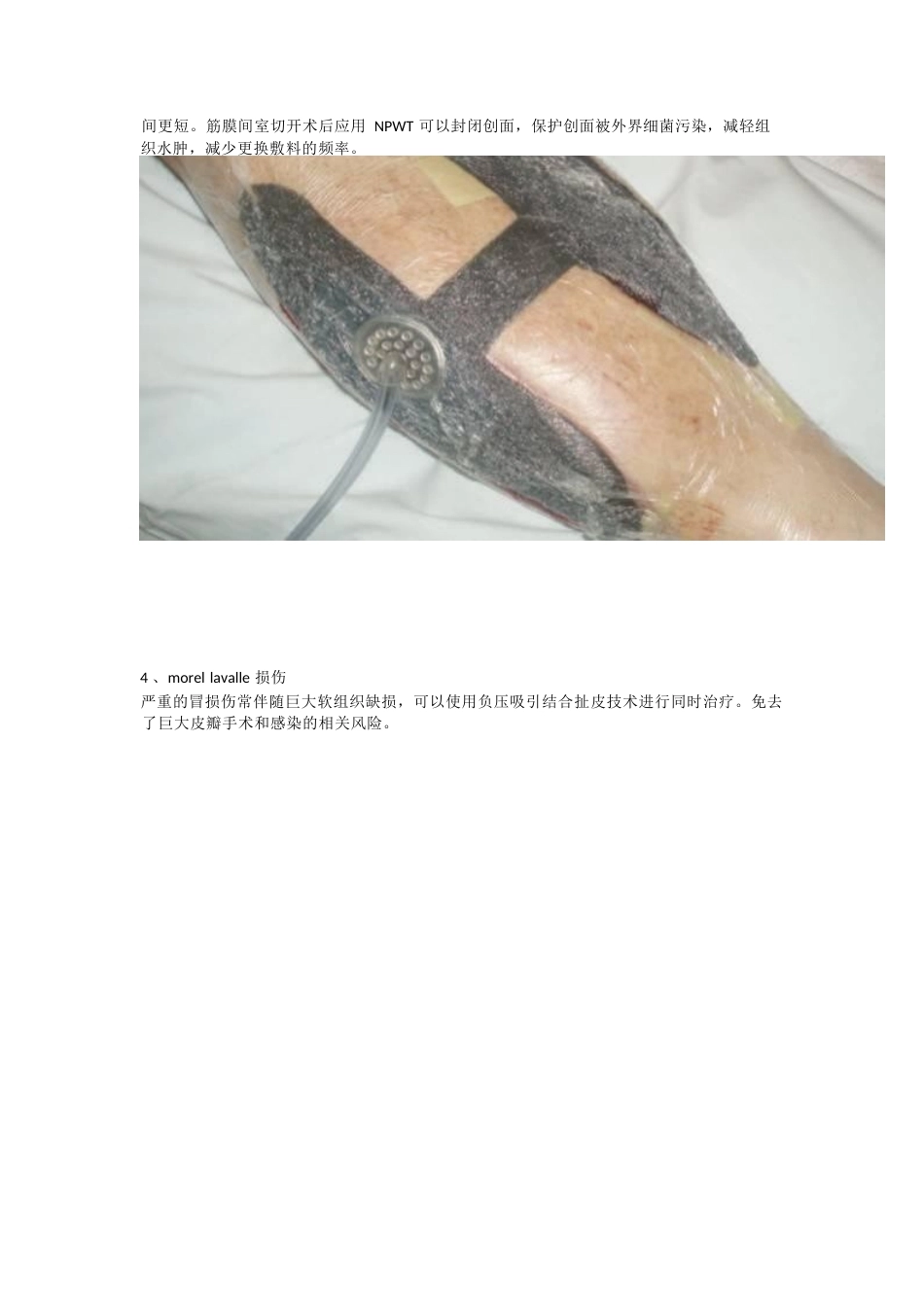 负压封闭引流技术治疗 软组织损伤_第6页