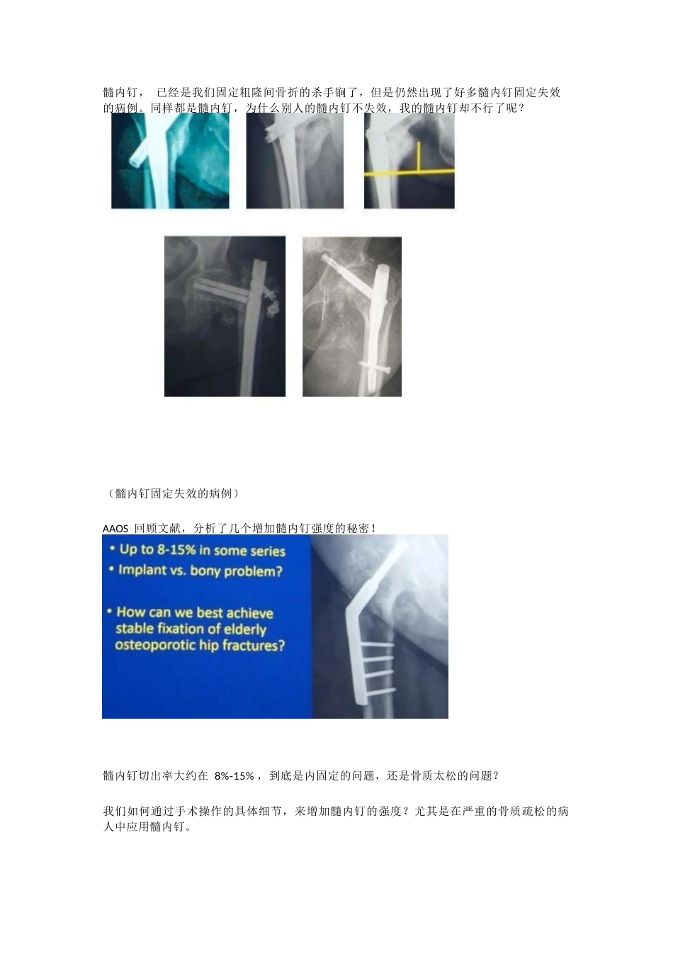 如何提高髓内钉的 内固定强度_第1页