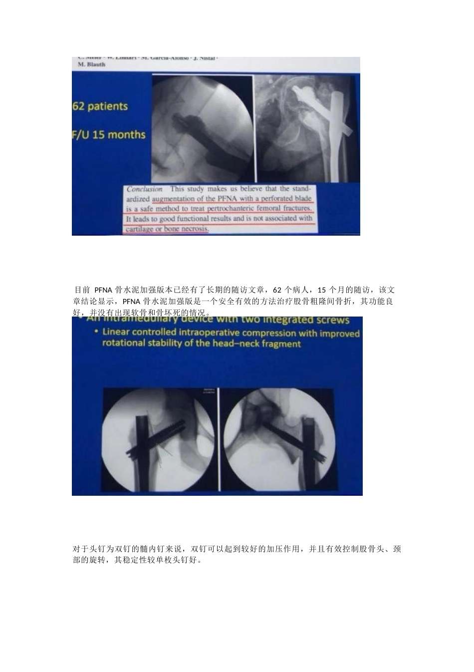 如何提高髓内钉的 内固定强度_第10页