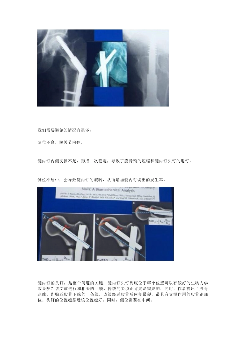 如何提高髓内钉的 内固定强度_第3页