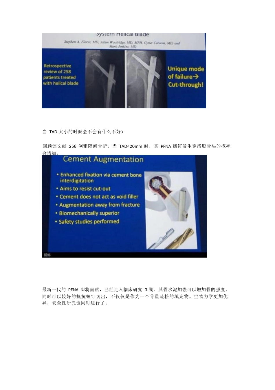 如何提高髓内钉的 内固定强度_第7页