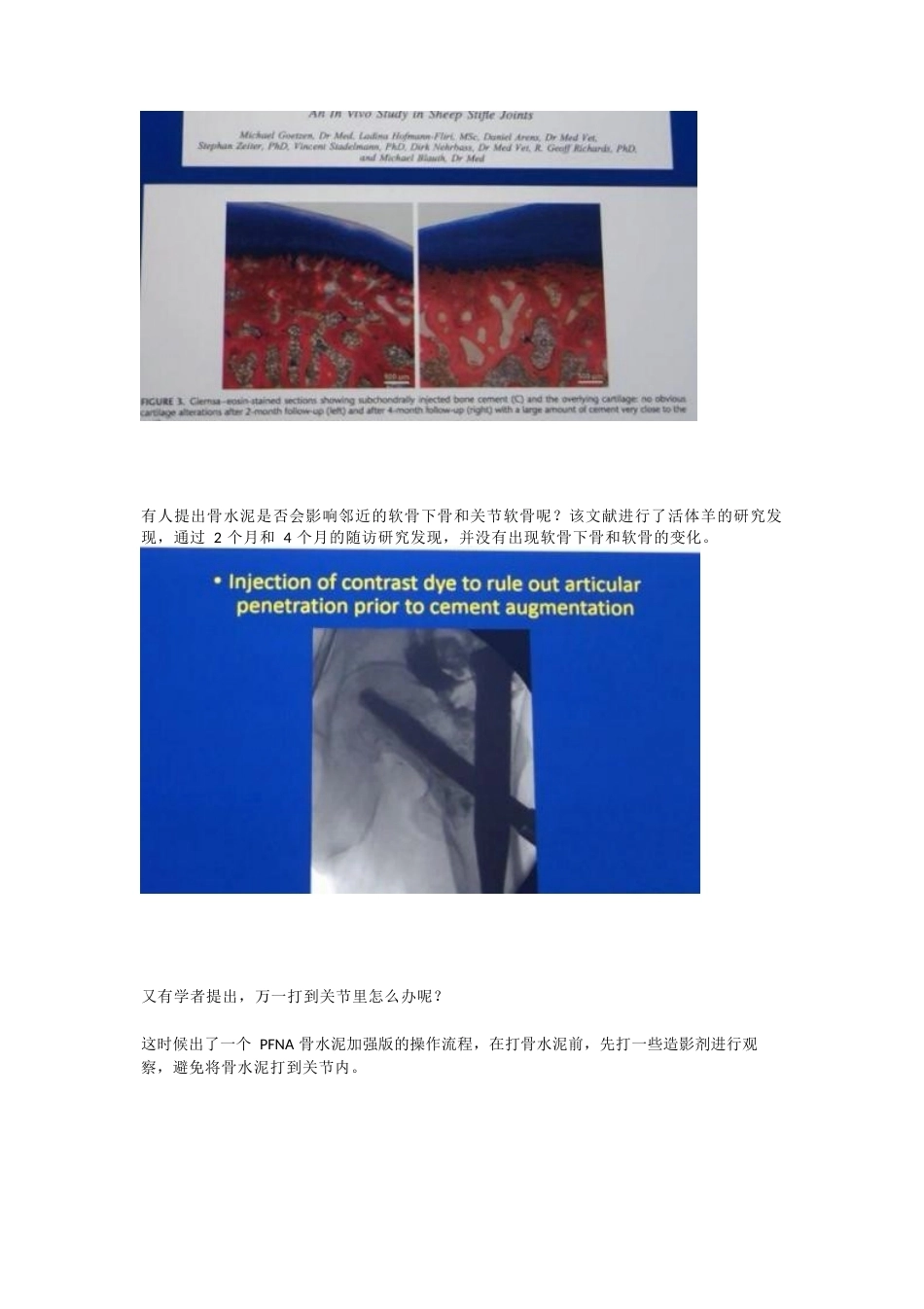 如何提高髓内钉的 内固定强度_第9页