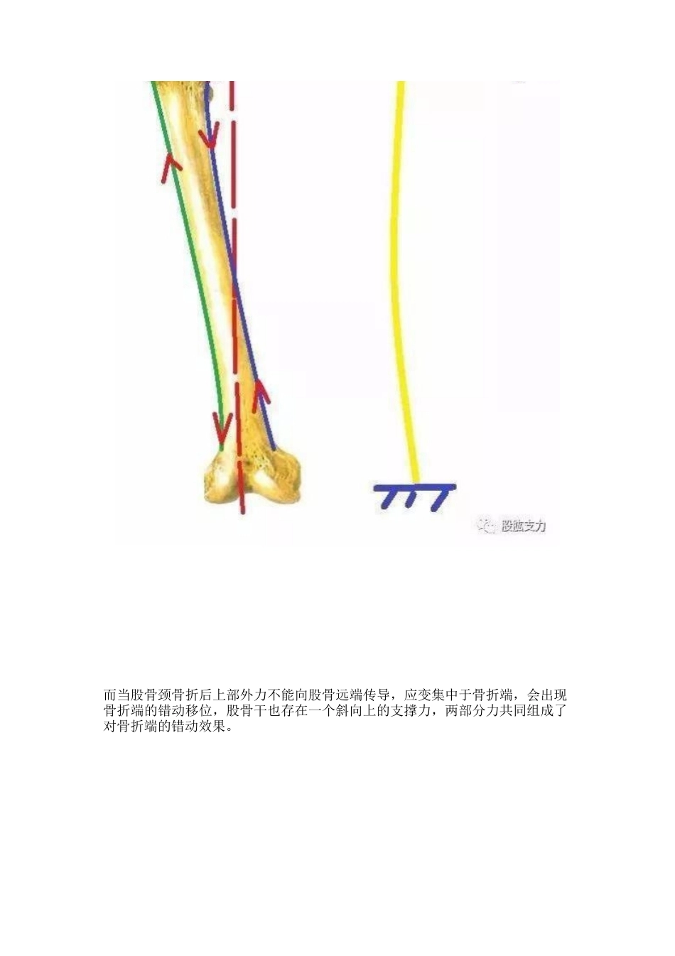 弯曲力原理及其在骨科领 域的应用_第14页