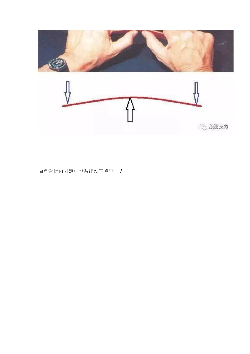 弯曲力原理及其在骨科领 域的应用_第5页
