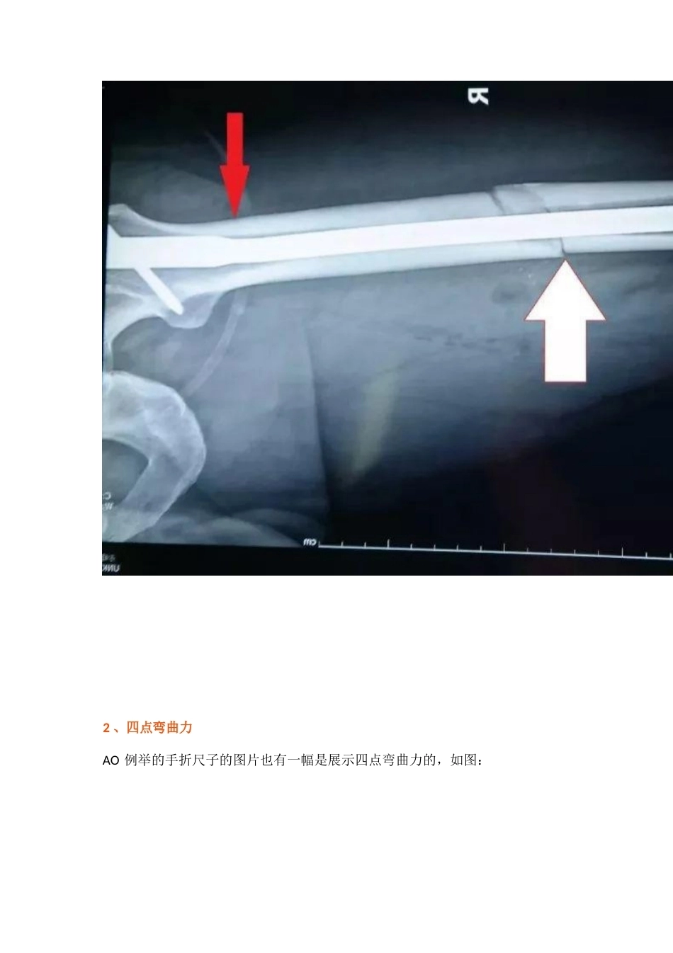 弯曲力原理及其在骨科领 域的应用_第6页