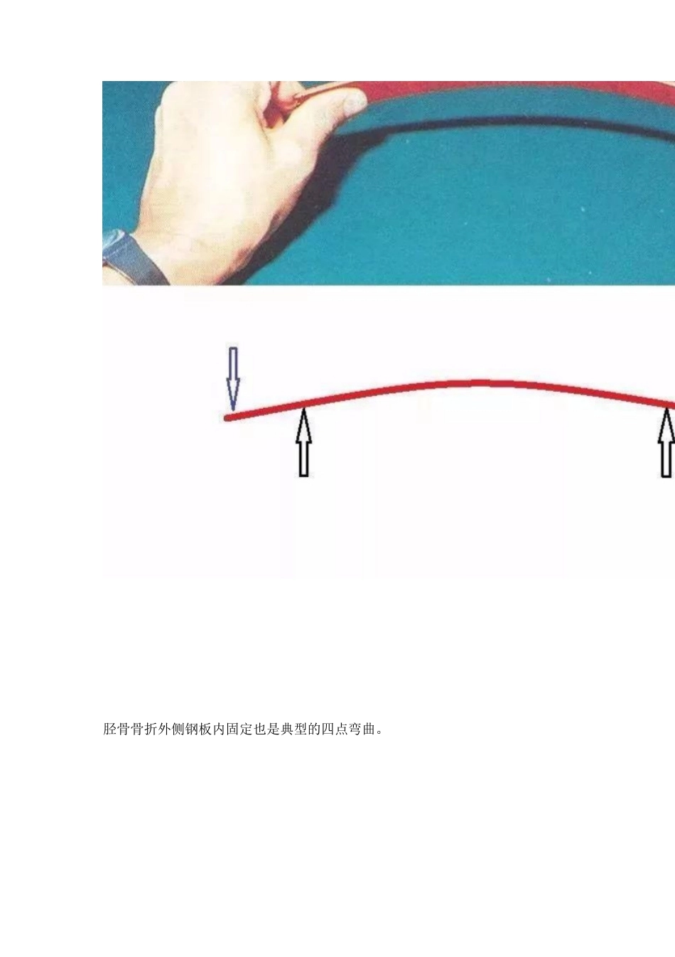 弯曲力原理及其在骨科领 域的应用_第7页