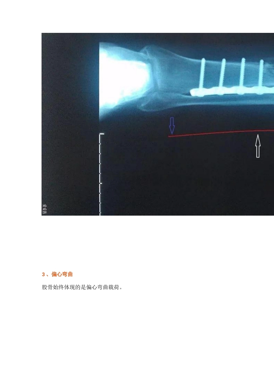 弯曲力原理及其在骨科领 域的应用_第8页